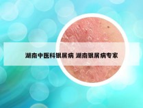 湖南中医科银屑病 湖南银屑病专家