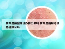 有牛皮癣健康证办得出来吗 有牛皮病癣可以办健康证吗
