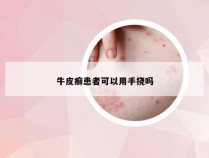 牛皮癣患者可以用手挠吗
