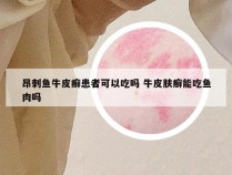 昂刺鱼牛皮癣患者可以吃吗 牛皮肤癣能吃鱼肉吗