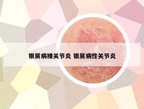 银屑病裸关节炎 银屑病性关节炎