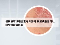 银屑病可以喂宝宝吃母乳吗 银屑病患者可以给宝宝吃母乳吗