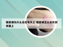银屑病为什么会在龟头上 银屑病怎么会长到阴囊上