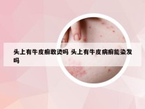 头上有牛皮癣敢烫吗 头上有牛皮病癣能染发吗