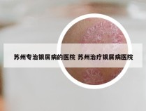 苏州专治银屑病的医院 苏州治疗银屑病医院