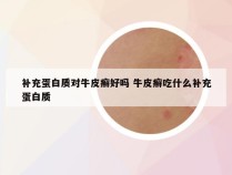 补充蛋白质对牛皮癣好吗 牛皮癣吃什么补充蛋白质