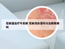 花椒酒治疗牛皮癣 花椒泡白酒可以治银屑病吗