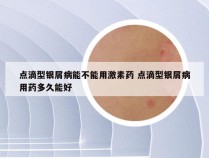 点滴型银屑病能不能用激素药 点滴型银屑病用药多久能好