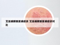 艾滋病跟银屑病症状 艾滋病跟银屑病症状对比