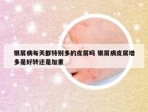 银屑病每天都特别多的皮屑吗 银屑病皮屑增多是好转还是加重