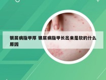 银屑病指甲厚 银屑病指甲长出来是软的什么原因