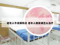 老年人牛皮癣特点 老年人银屑病怎么治疗