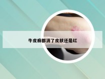 牛皮癣都消了皮肤还是红