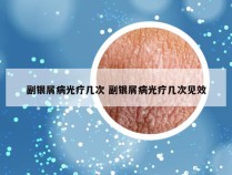 副银屑病光疗几次 副银屑病光疗几次见效