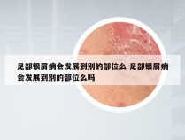 足部银屑病会发展到别的部位么 足部银屑病会发展到别的部位么吗