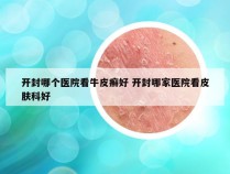 开封哪个医院看牛皮癣好 开封哪家医院看皮肤科好