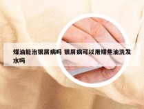 煤油能治银屑病吗 银屑病可以用煤焦油洗发水吗