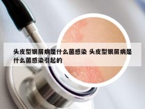 头皮型银屑病是什么菌感染 头皮型银屑病是什么菌感染引起的