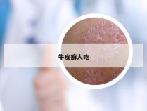 牛皮癣人吃