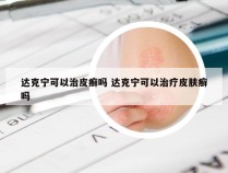 达克宁可以治皮癣吗 达克宁可以治疗皮肤癣吗