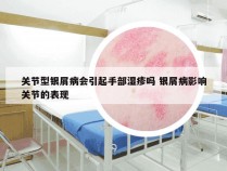 关节型银屑病会引起手部湿疹吗 银屑病影响关节的表现