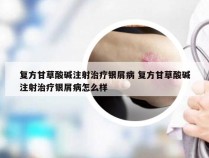 复方甘草酸碱注射治疗银屑病 复方甘草酸碱注射治疗银屑病怎么样