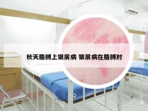 秋天胳膊上银屑病 银屑病在胳膊肘