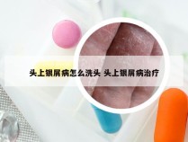 头上银屑病怎么洗头 头上银屑病治疗
