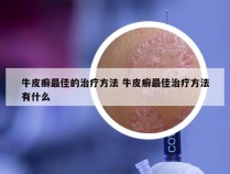 牛皮癣最佳的治疗方法 牛皮癣最佳治疗方法有什么