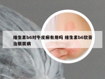 维生素b6对牛皮癣有用吗 维生素b6软膏治银屑病