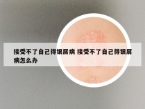 接受不了自己得银屑病 接受不了自己得银屑病怎么办