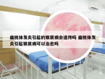 扁桃体发炎引起的银屑病会遗传吗 扁桃体发炎引起银屑病可以治愈吗