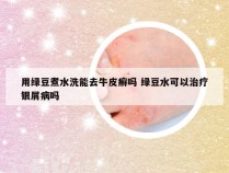 用绿豆煮水洗能去牛皮癣吗 绿豆水可以治疗银屑病吗
