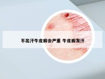 不出汗牛皮癣会严重 牛皮癣发汗