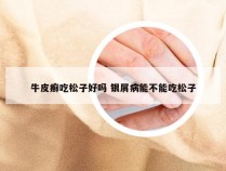 牛皮癣吃松子好吗 银屑病能不能吃松子