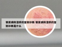 银屑病和湿疹的鉴别诊断 银屑病和湿疹的鉴别诊断是什么