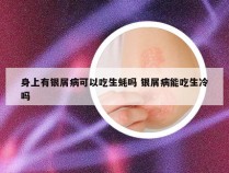 身上有银屑病可以吃生蚝吗 银屑病能吃生冷吗