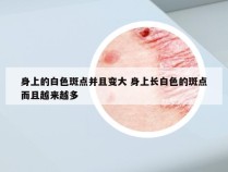 身上的白色斑点并且变大 身上长白色的斑点而且越来越多