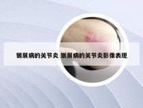 银屑病的关节炎 银屑病的关节炎影像表现