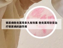 银屑病他克莫司多久有效果 他克莫司软膏治疗银屑病的副作用