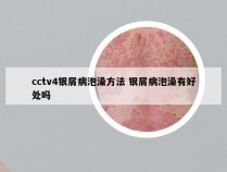 cctv4银屑病泡澡方法 银屑病泡澡有好处吗