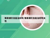 银屑病针灸能治好吗 银屑病针灸能治好吗女性