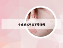 牛皮癣关节炎不看行吗