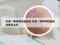 头皮一块块发红起白皮 头皮一块块发红起白皮屑怎么办