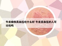 牛皮癣和高血压吃什么好 牛皮高血压的人可以吃吗