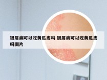 银屑病可以吃黄瓜皮吗 银屑病可以吃黄瓜皮吗图片