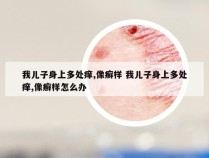 我儿子身上多处痒,像癣样 我儿子身上多处痒,像癣样怎么办