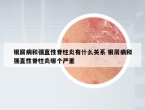 银屑病和强直性脊柱炎有什么关系 银屑病和强直性脊柱炎哪个严重