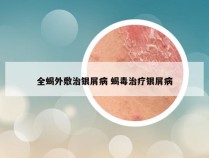 全蝎外敷治银屑病 蝎毒治疗银屑病