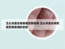 怎么快速去除脓疱型银屑病 怎么快速去除脓疱型银屑病的皮肤
